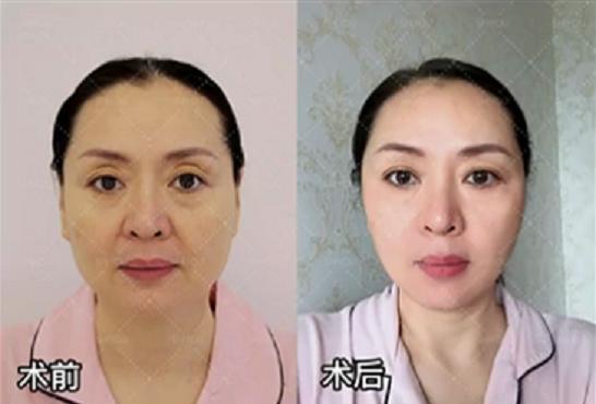 「46岁的赵女士」PSV面部提升术后90天，亲身经历谈谈我的感受